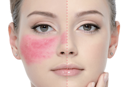 Rosacea