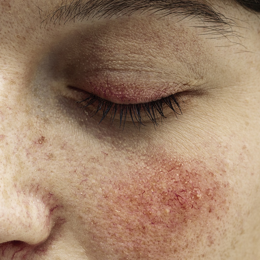 Rosacea